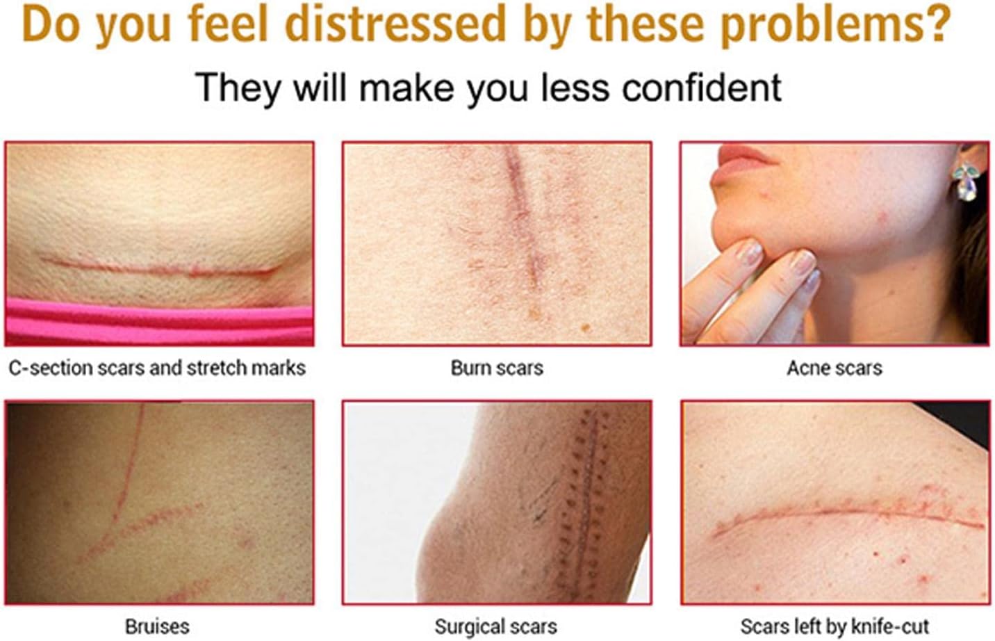 Acne Scar Removal Rejuvenation Serum | Scar, C section &amp; Stretch Mark Removal Oil for women