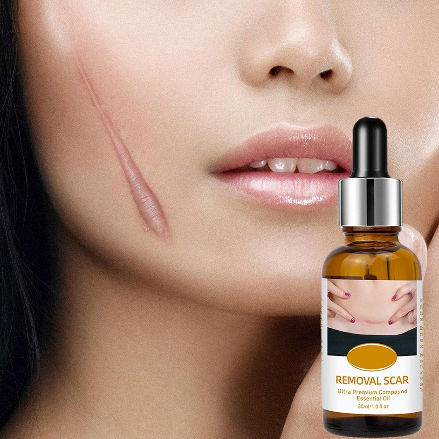 Acne Scar Removal Rejuvenation Serum | Scar, C section &amp; Stretch Mark Removal Oil for women